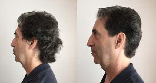 Rouel's Profile before & after